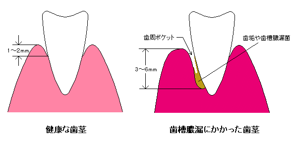 歯茎の比較