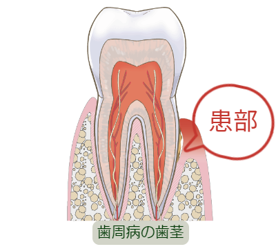 歯周病を理解しよう